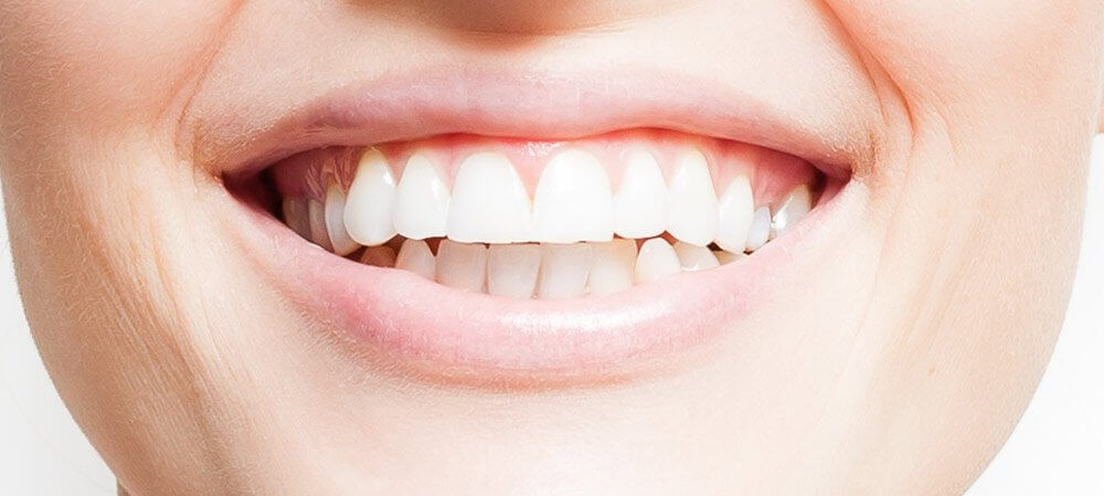 Gummy Smile Correction