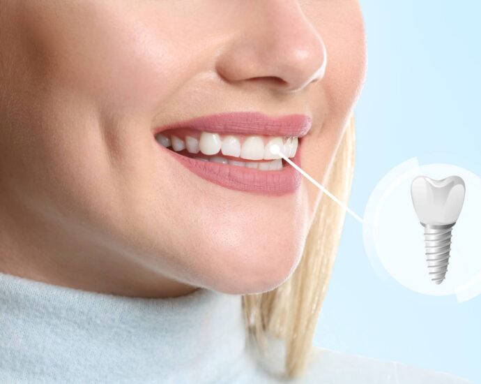 Dental Implants