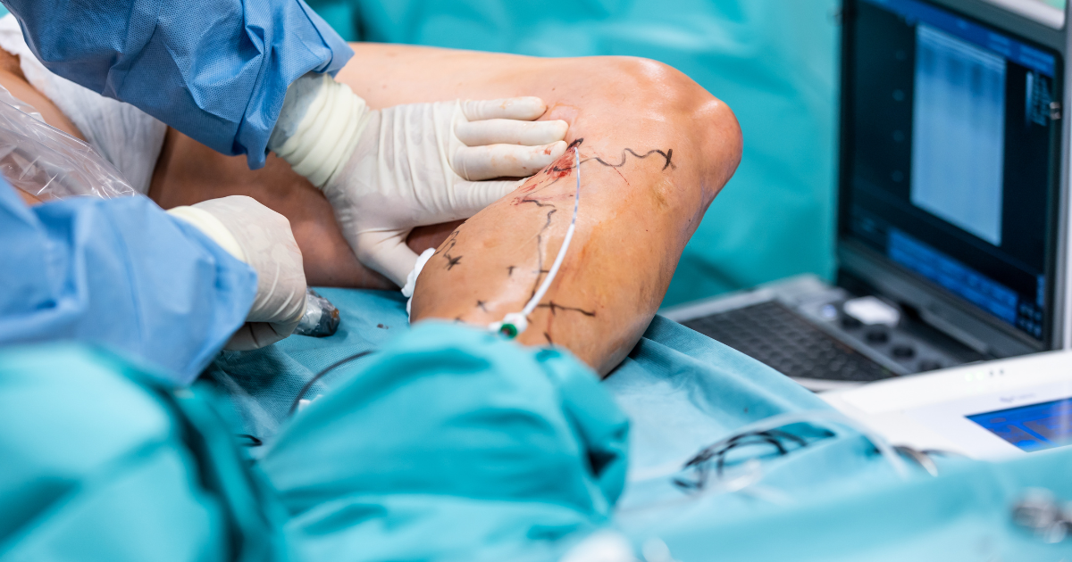 Varicose Veins Laser Therapy